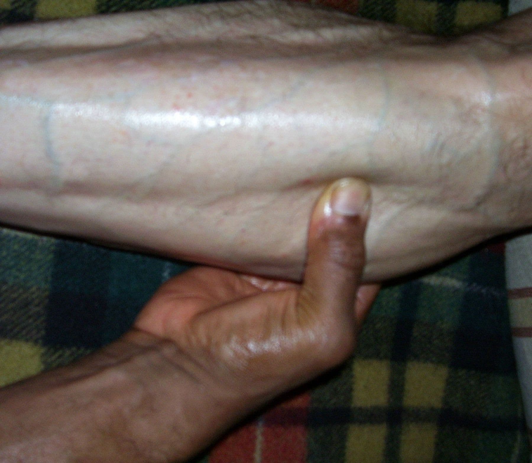 Bill’s thumb working along the fascia of a forearm